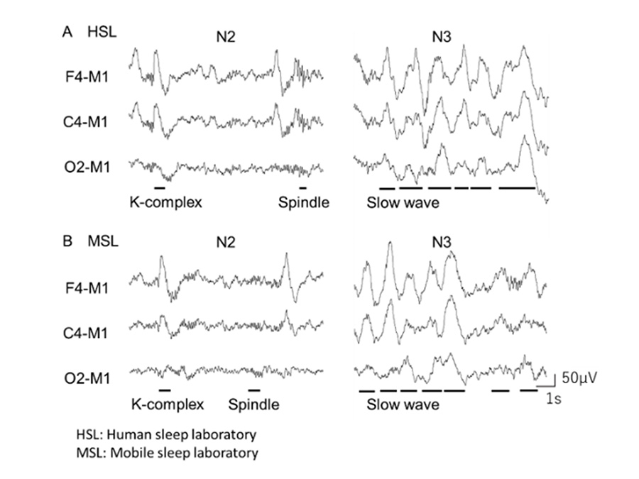 Section of PSG study results (sleep electroencephalograms) in the Human Sleep Lab (top) and Mobile Sleep Lab (bottom). The unique waveforms were equally observed in each sleep stage.